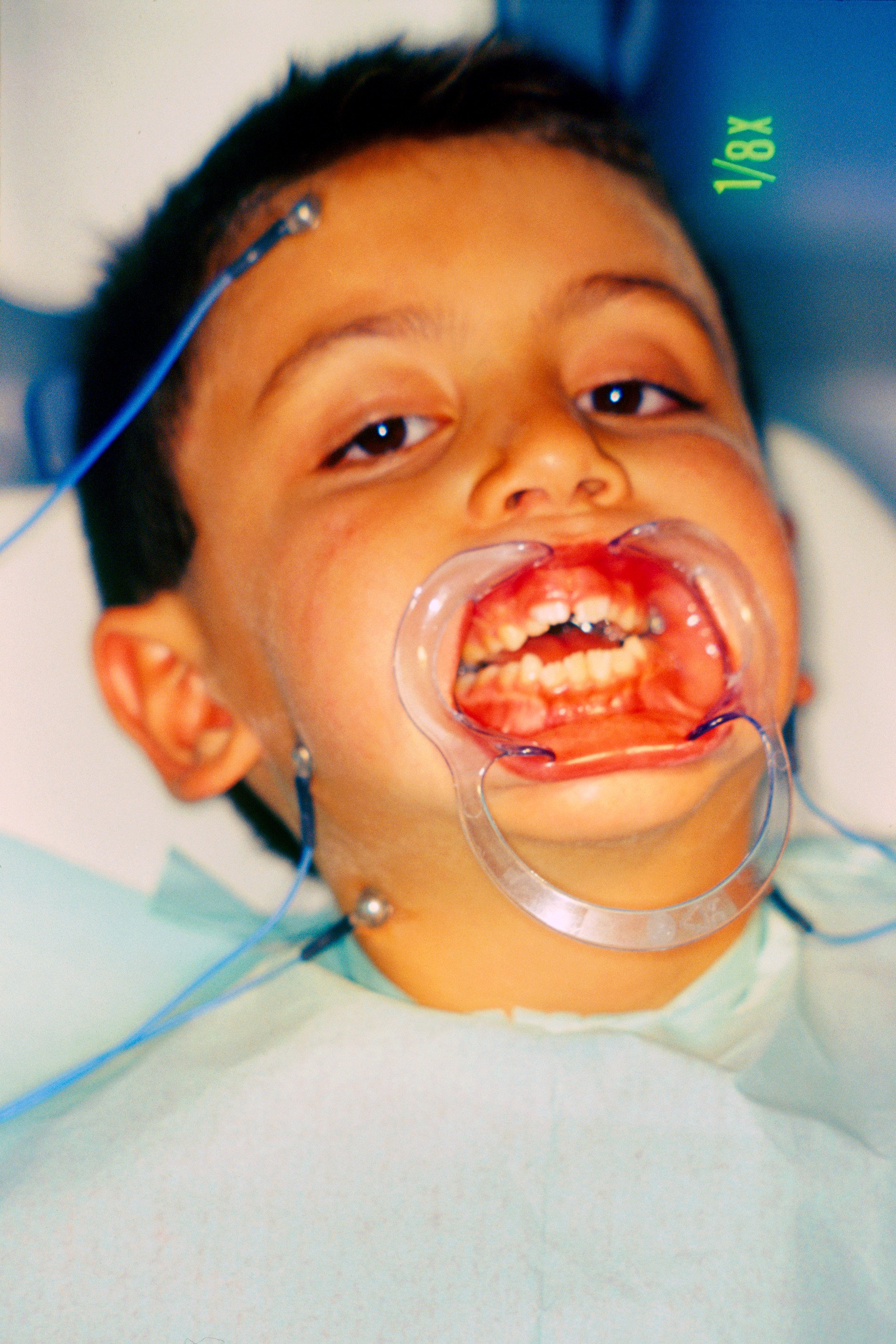 Orthodontie interceptive